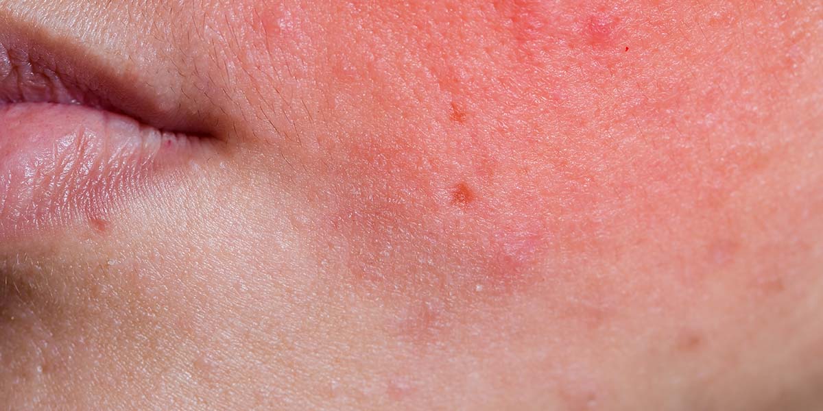 When to Avoid Cosmetic Treatments