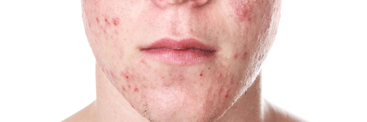 How to Care for Acne-Prone Teenage skin