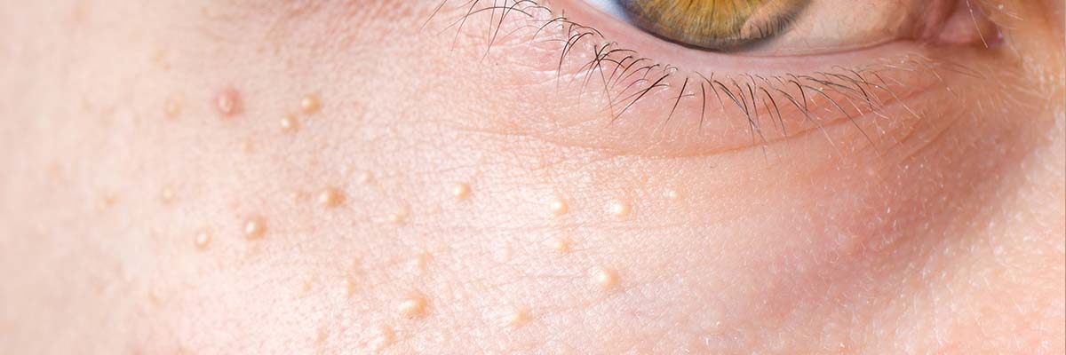 Milia Dos and Don’ts