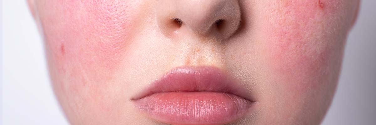 Rosacea Dos and Don’ts