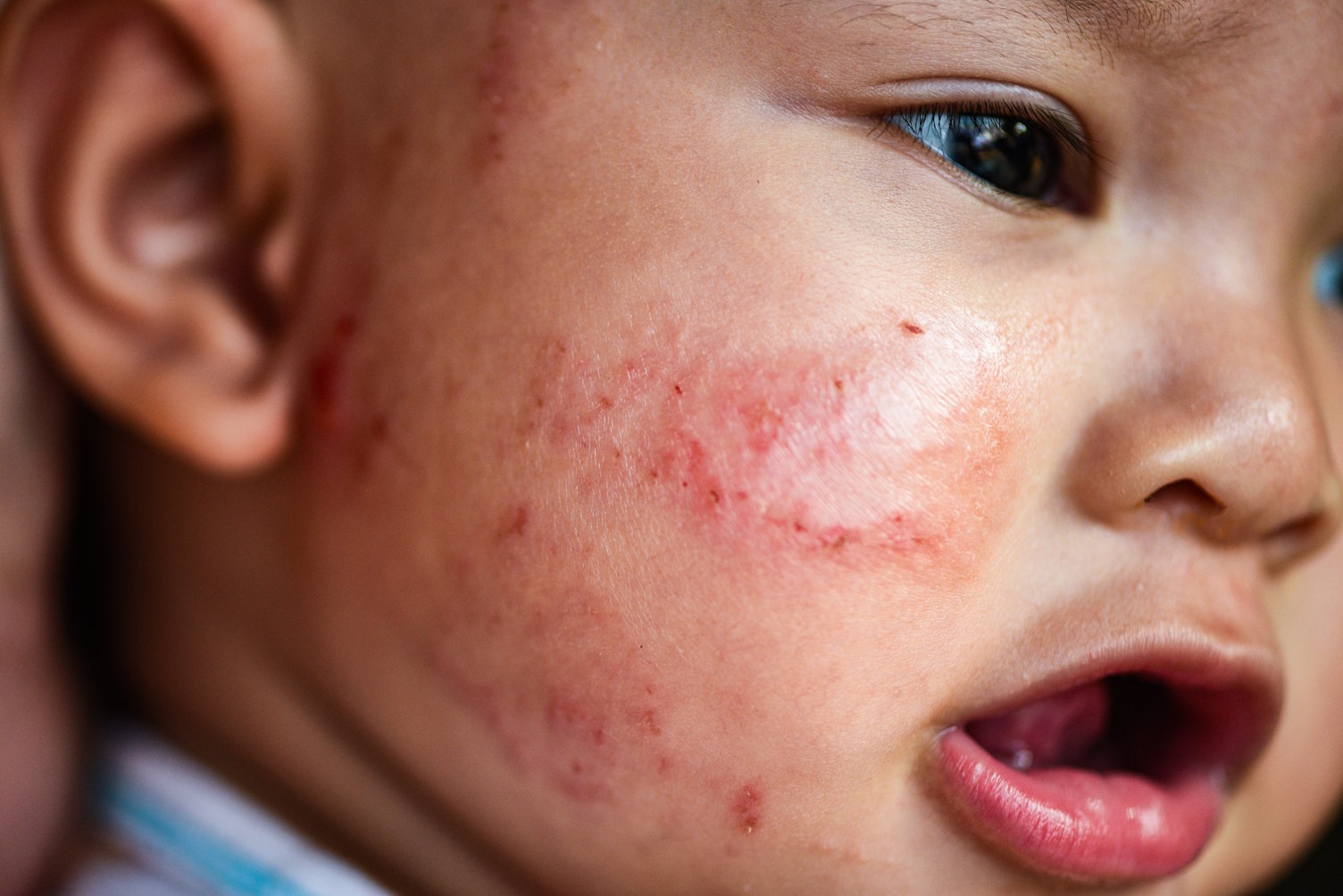 AMPERNA-Eczema_fbe31ad4-1e53-47a9-ad53-27da71e3ac47.jpg