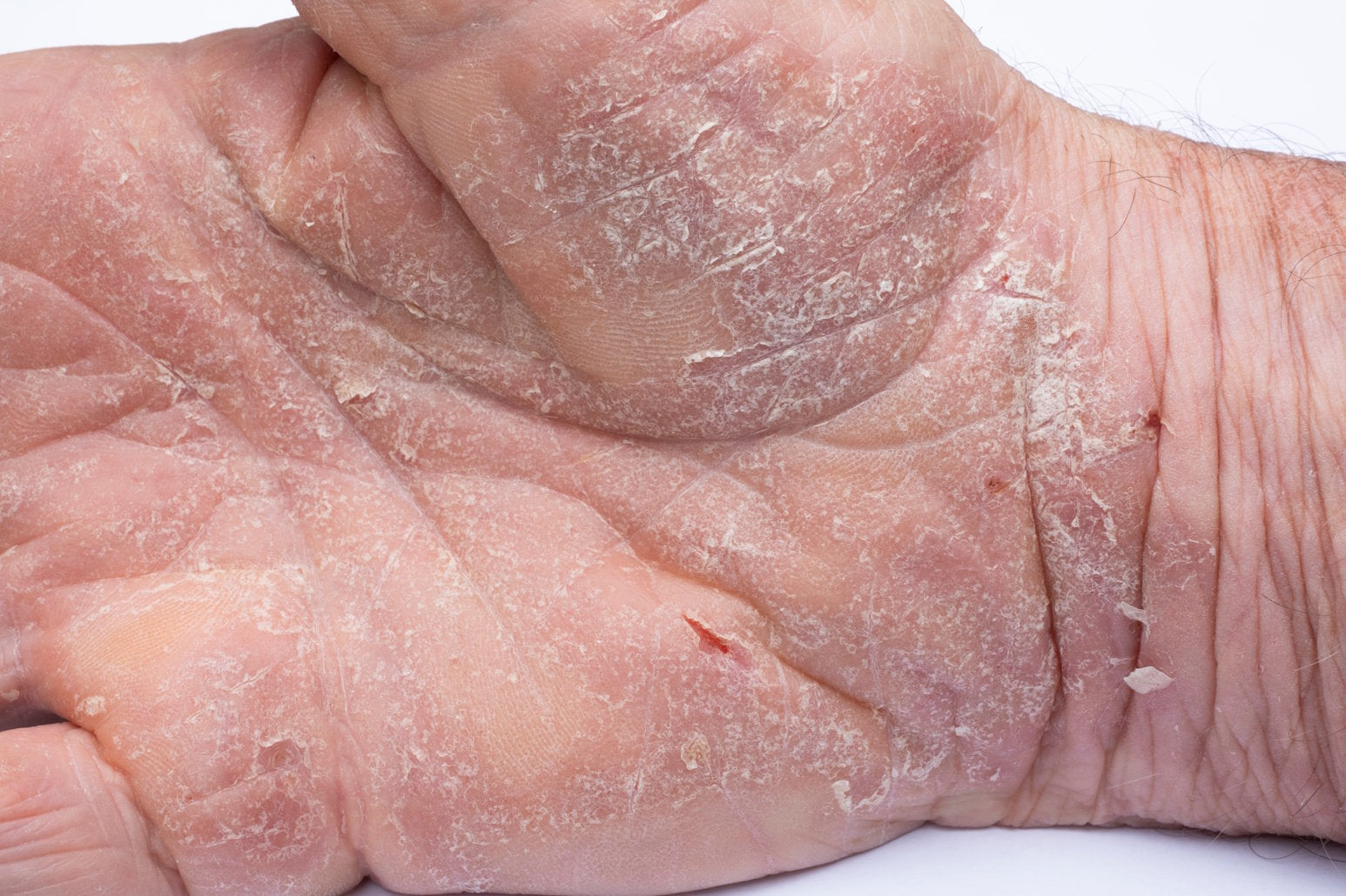 AMPERNA-Skin-Concerns-Eczema.jpg