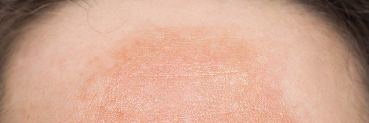 AMPERNA Melasma