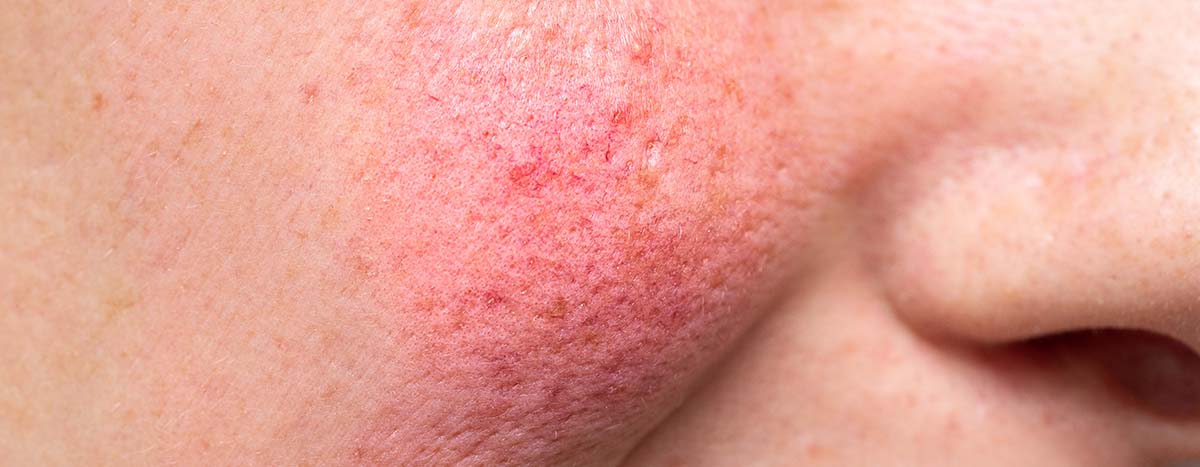 AMPERNA Rosacea flared skin