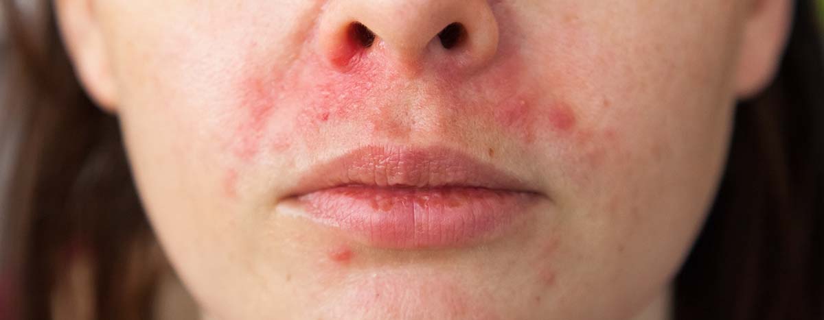 AMPERNA Perioral Dermatitis