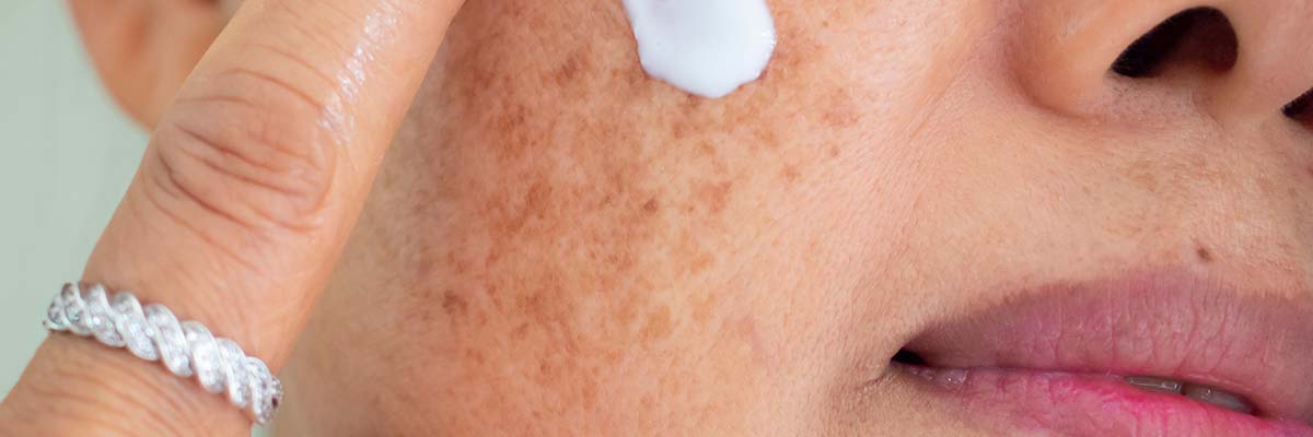 AMPERNA Pigmentation on skin