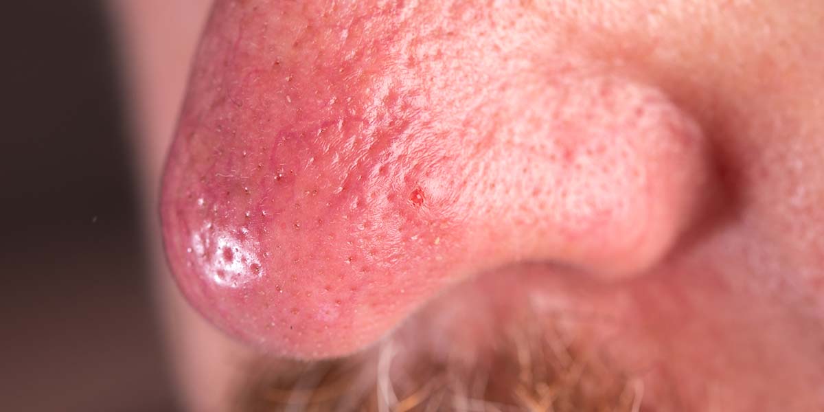 Rosacea: Understanding the 4 Types, Causes & Treatment