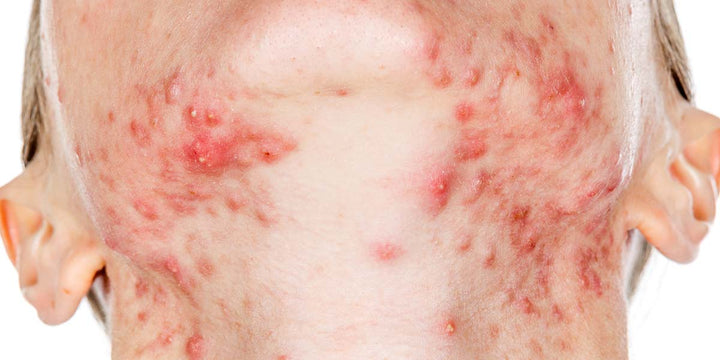 The 6 Types of Acne Explained. Which one do you suffer from?
