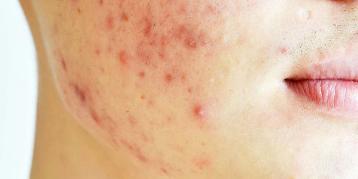 Skincare 101: Acne and Probiotics