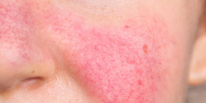 Help for Acne and Rosacea