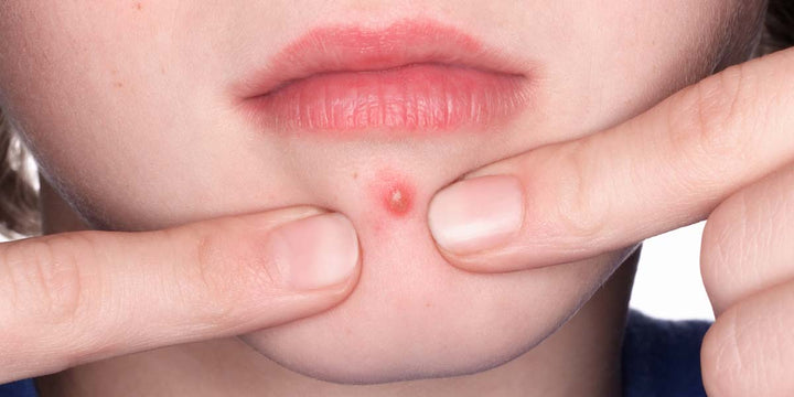What to Avoid if you Have Acne