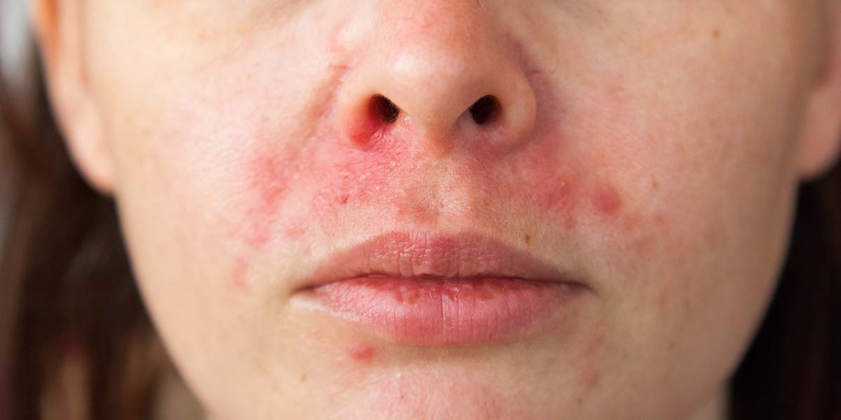 So You Have Perioral Dermatitis; Now What?