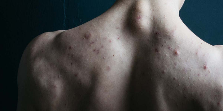 What is Back Acne and How Can You Treat it Holistically?