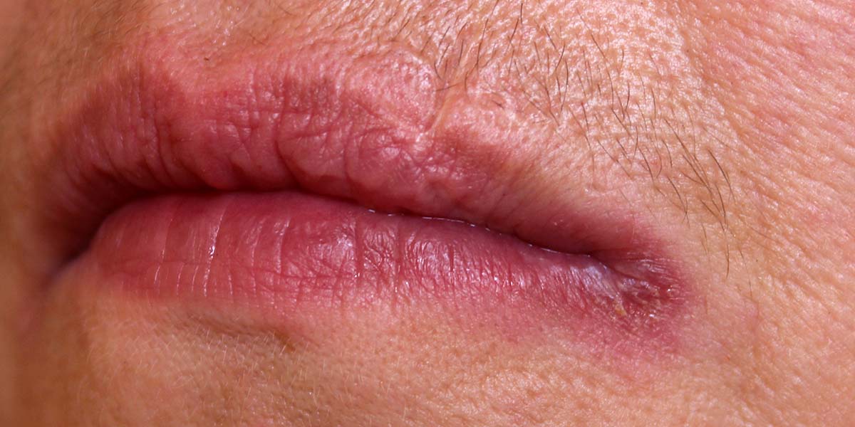 Skin Conditions on and Around Your Mouth