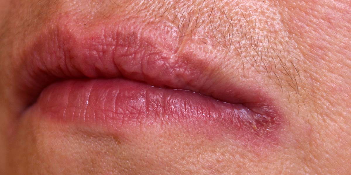 Angular Cheilitis vs Perioral Dermatitis: How to Tell the Difference