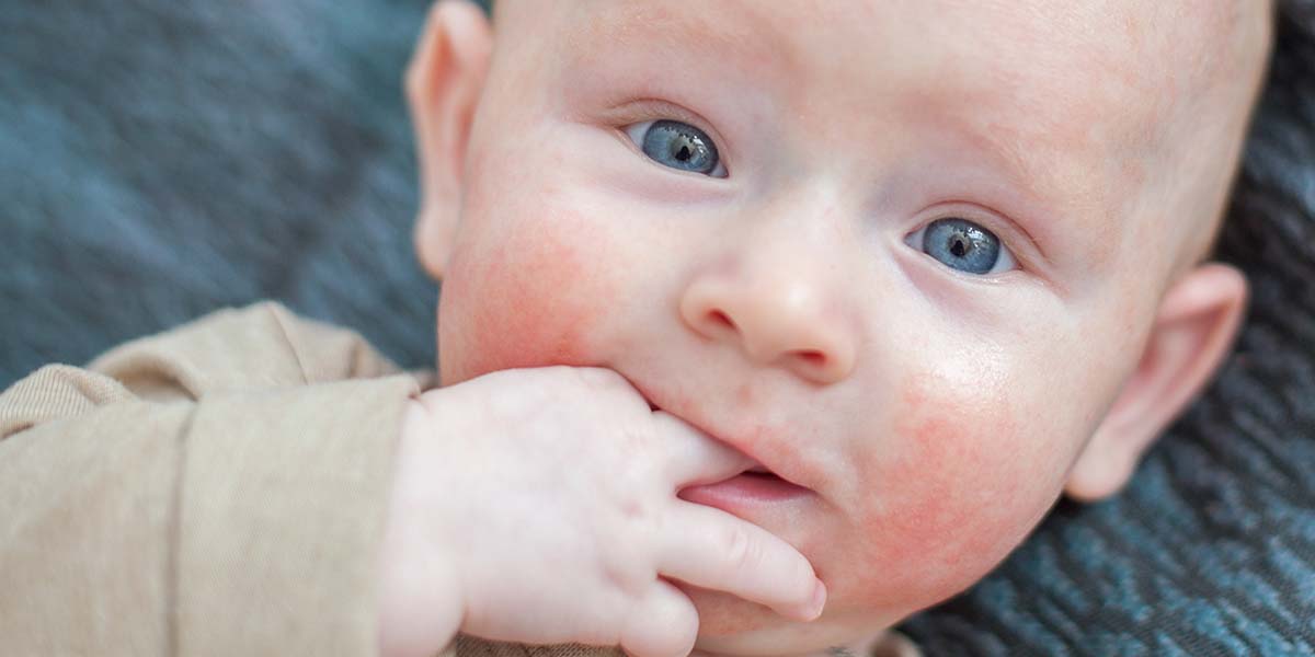 Help for Children Suffering From Dermatitis
