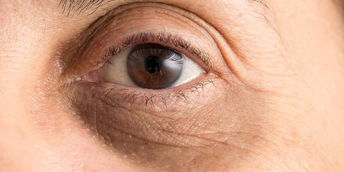 Dark Circles Under Your Eyes: Causes and Treatments