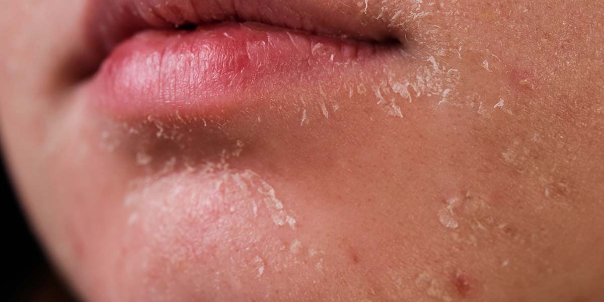 Dry or Dehydrated Skin: What's the Difference?