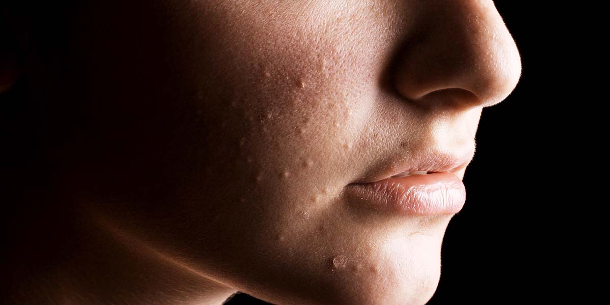How to Deal with Bad Skin Days with Liz AKA Pretty Progress
