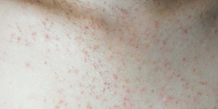 Is my Skin Issue Fungal? Should I Apply an Anti-Fungal Cream?