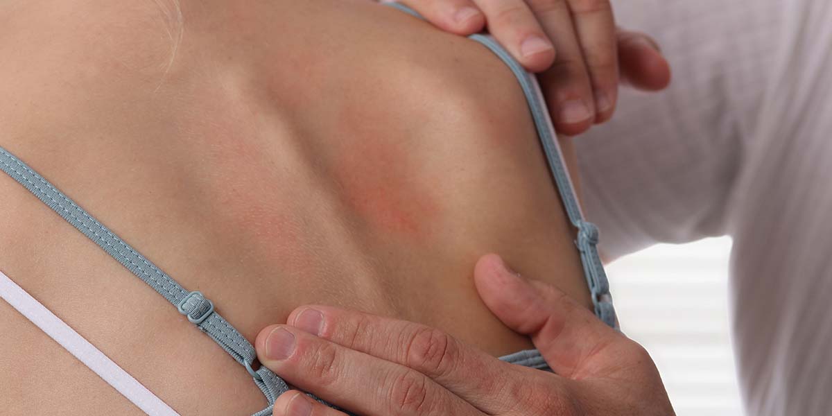 Could Histamines be Triggering Your Skin Condition?