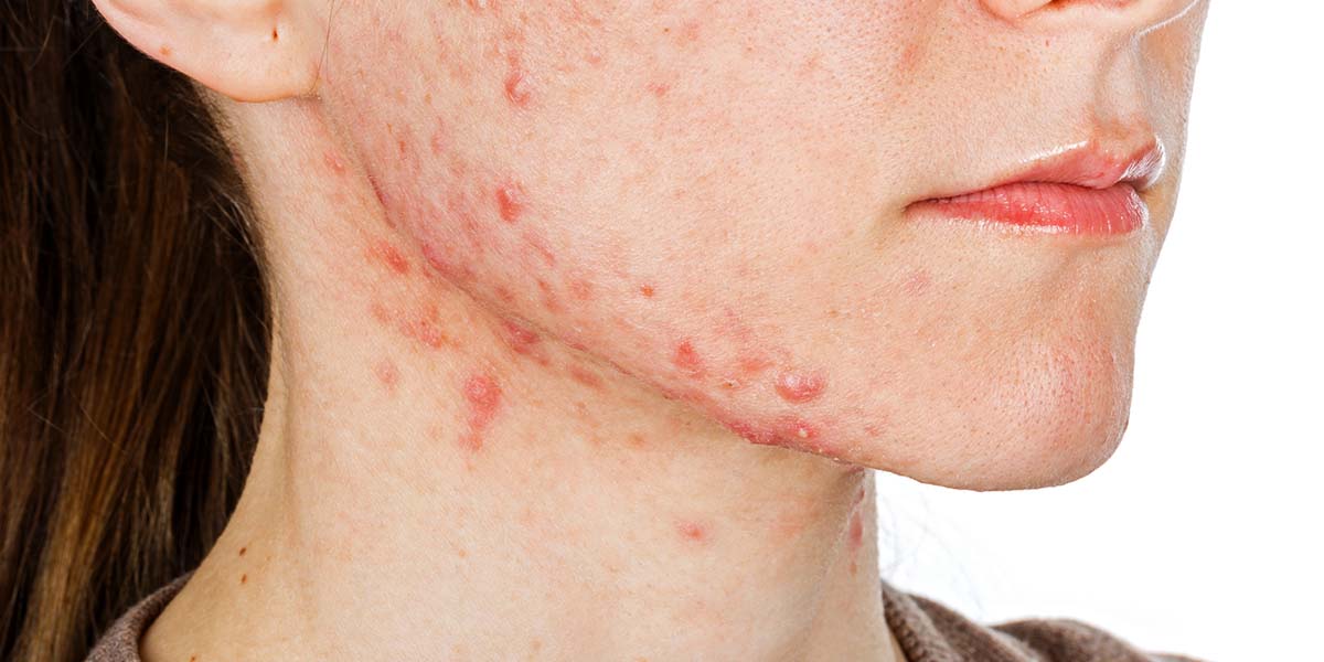 Managing Hormonal Acne