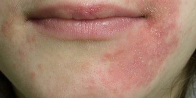 Are Mites to Blame for Perioral Dermatitis – AMPERNA®