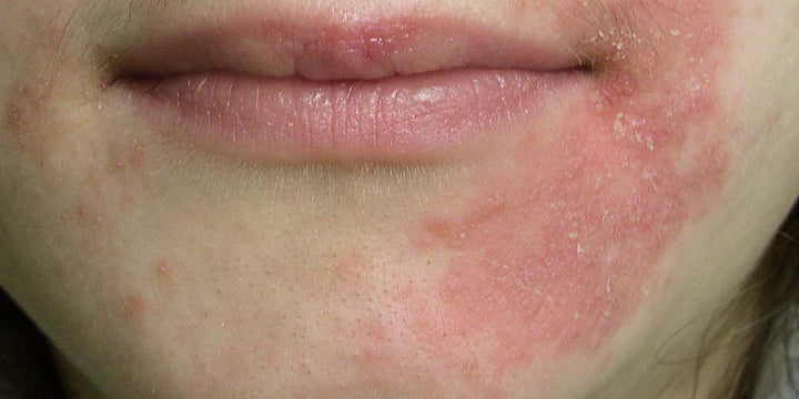 Are Mites to Blame for Perioral Dermatitis