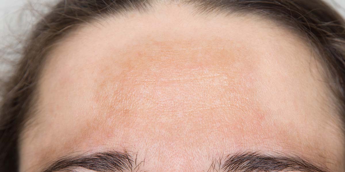 Help for Hyperpigmentation Sufferers