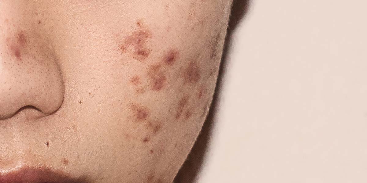 How to Remove Dark Spots Caused by Acne & Inflammation