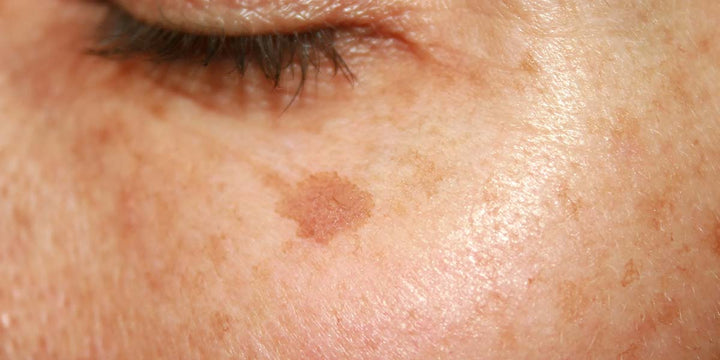 How to Restore Skin Brightness and Reduce Hyperpigmentation Spots