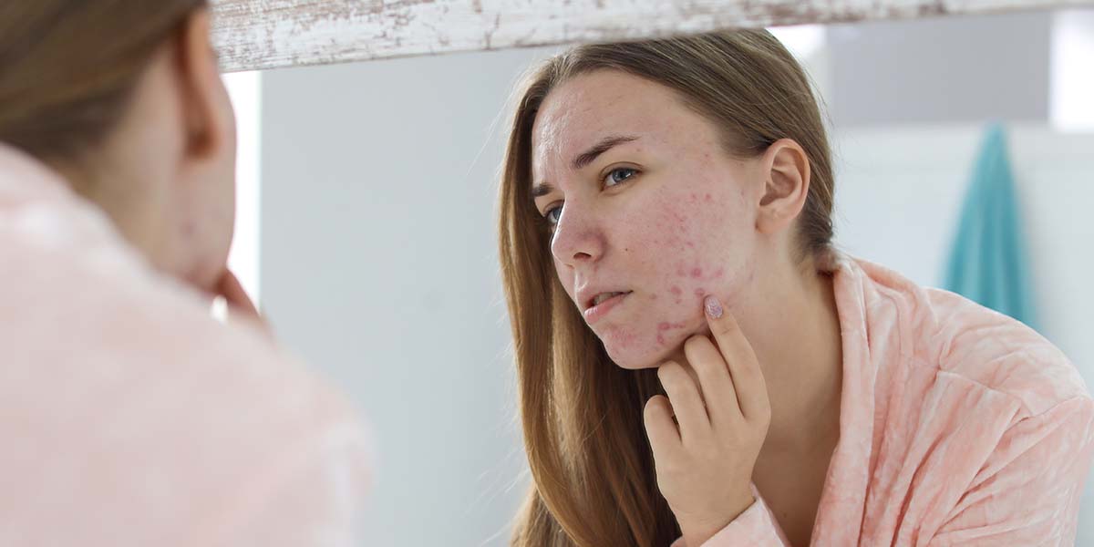 Skin Purging – What You Need to Know