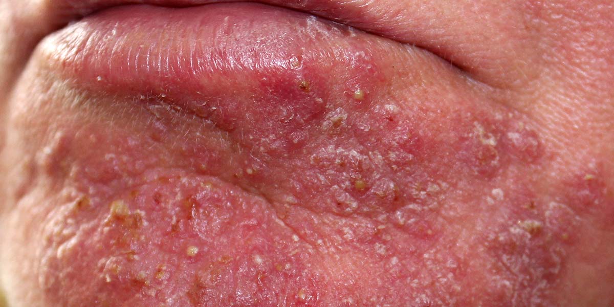 The Best Way to Manage & Clear Rosacea