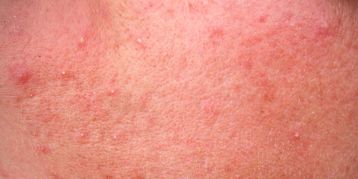 Adult Pimples, Rosacea and What to do About Them