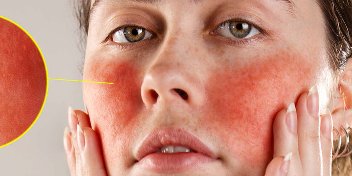 Skincare Coaching for Acne & Rosacea