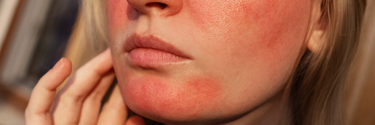 What Is the Best Skincare for Rosacea-Prone Skin?