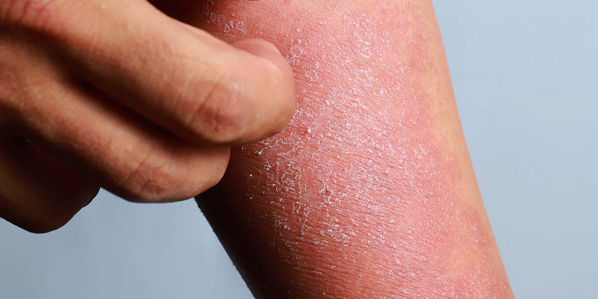 How to Care for Sensitive Skin: A Simple Skincare Routine