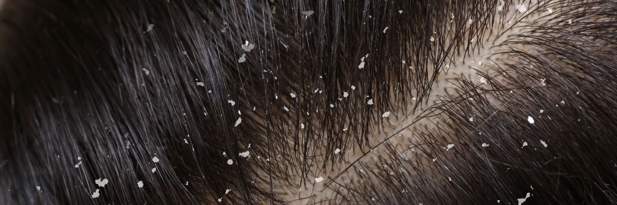 Dry Scalp vs Dandruff: What's the Difference?
