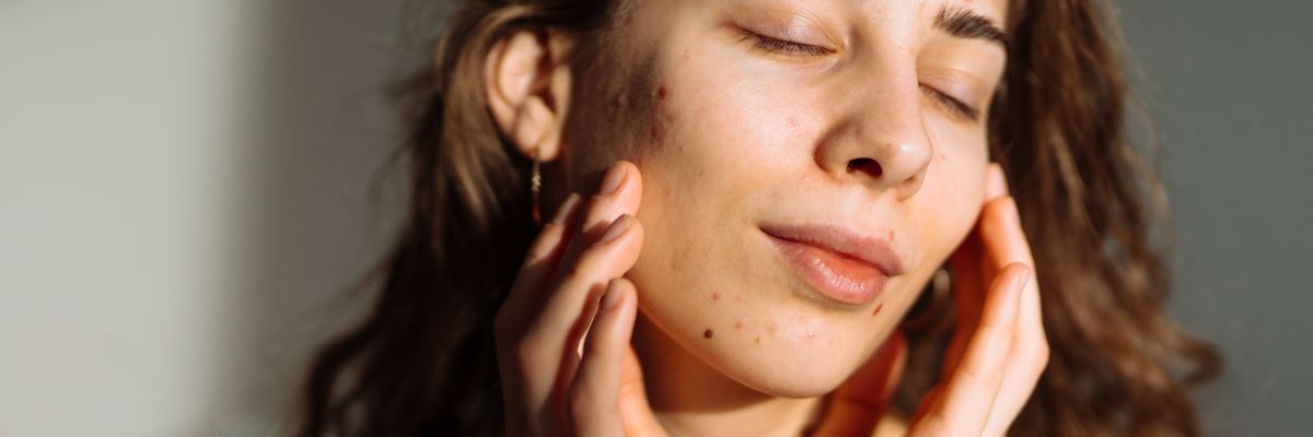 How Postbiotics Help Support Acne-Prone Skin
