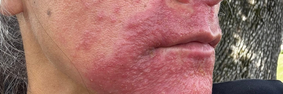 Tips on Treating Perioral Dermatitis