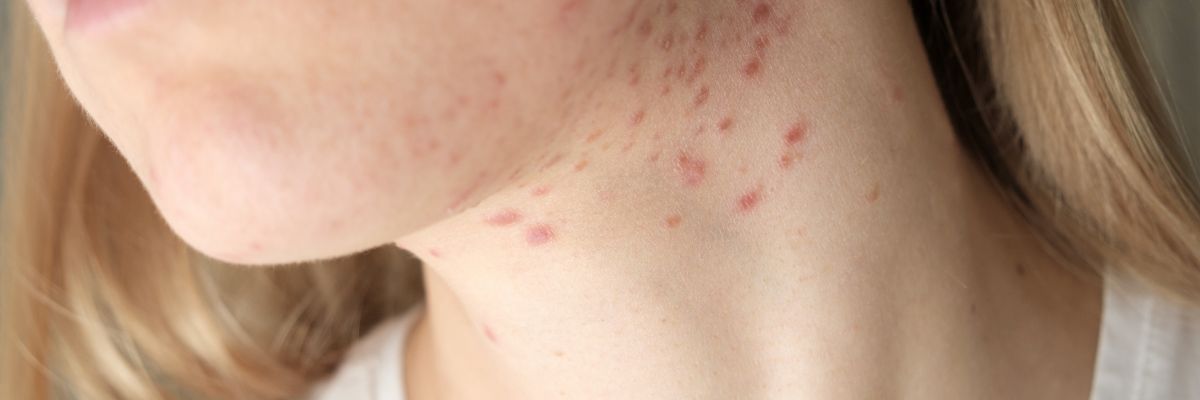 How To Support Acne-Prone Skin Without Over-Stripping It