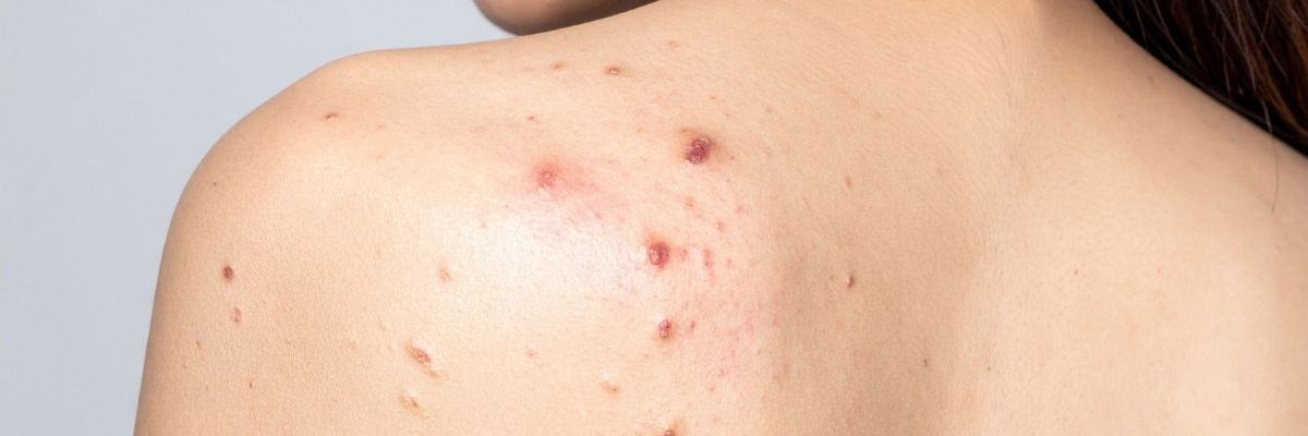 Back Acne: Why It Happens + How to Care for Breakout-Prone Body Skin