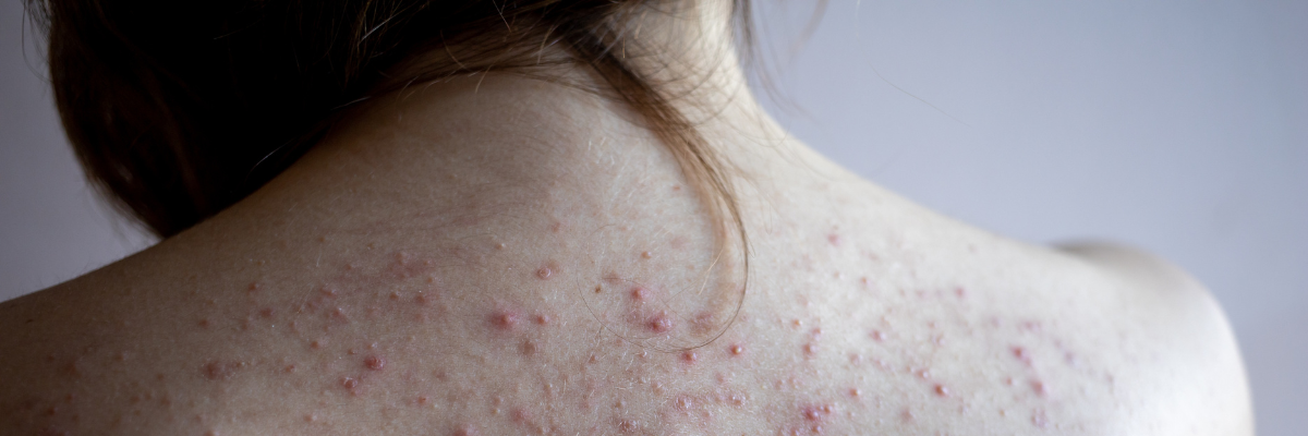 Chest + Back Breakouts: Could Your Haircare Be Contributing?