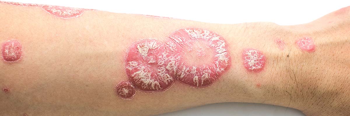 What Is Psoriasis And Can It Be Treated?