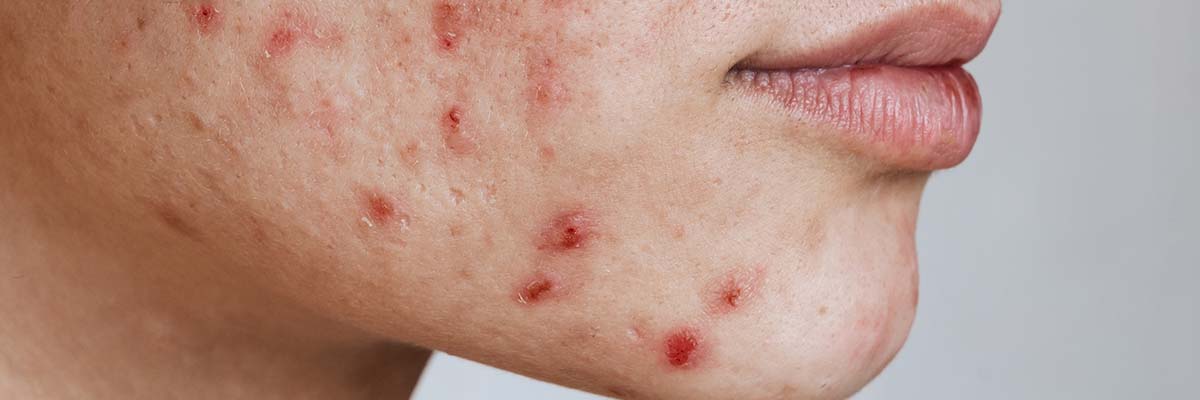 Suffering from Acne?