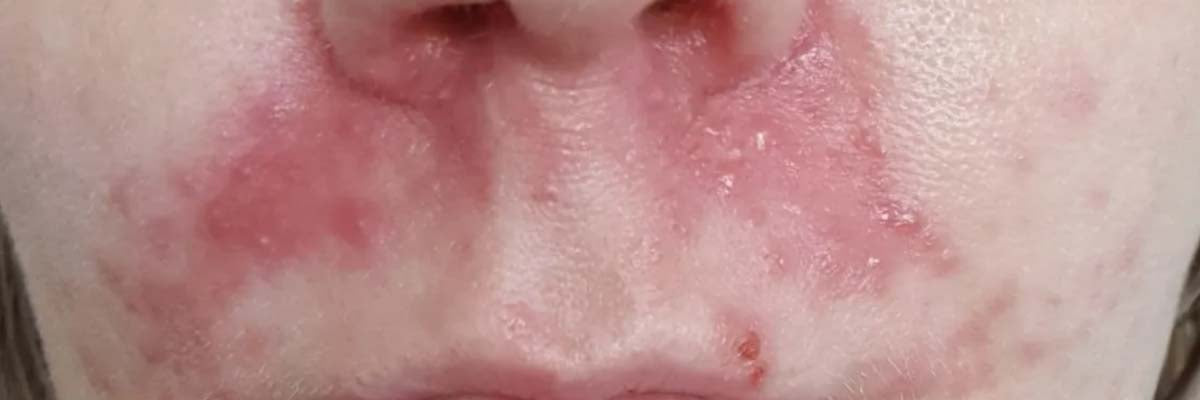 Perioral Dermatitis: Dos and Don’ts