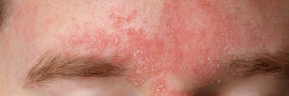 Seborrheic Dermatitis: Dos and Don’ts for Managing Flare-Ups