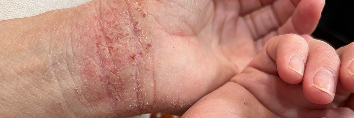 Topical Steroid Withdrawal Statistics