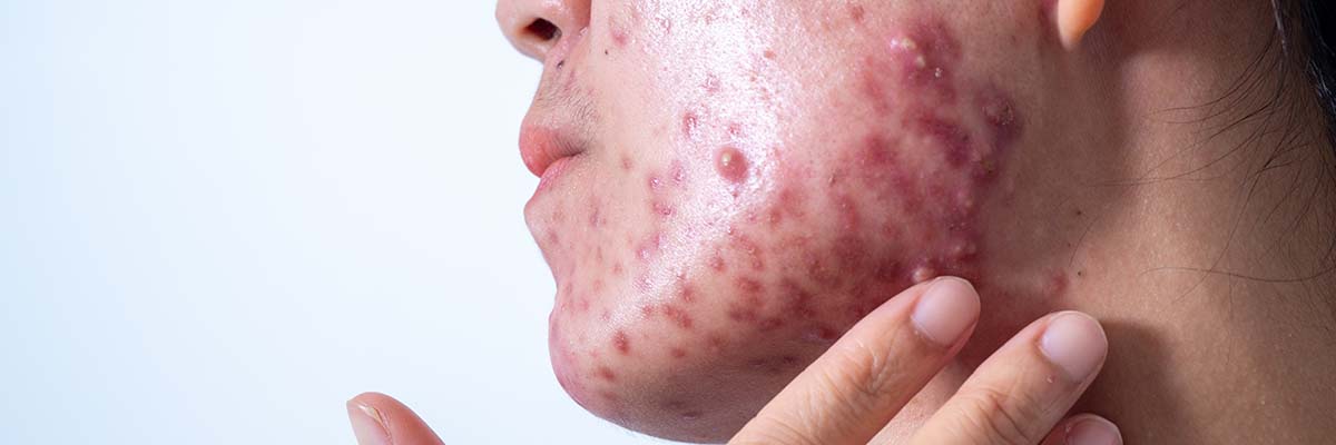 Looking Beyond your Acne