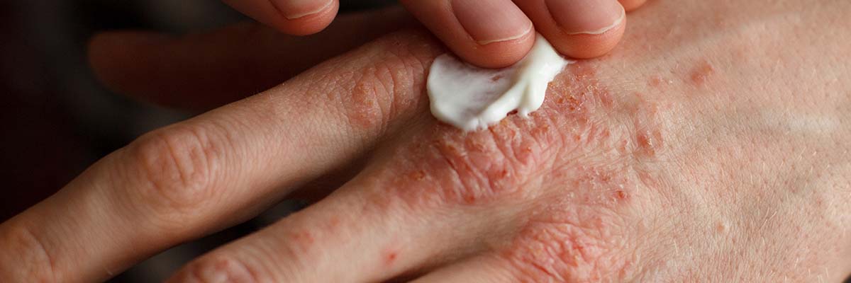 Eczema Dos and Don’ts